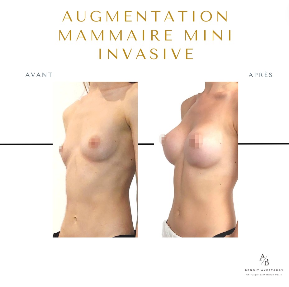 Augmentation mammaire par prothèses à Paris 1 Augmentation mammaire à Paris – résultat avant après n°1, Dr Ayestaray