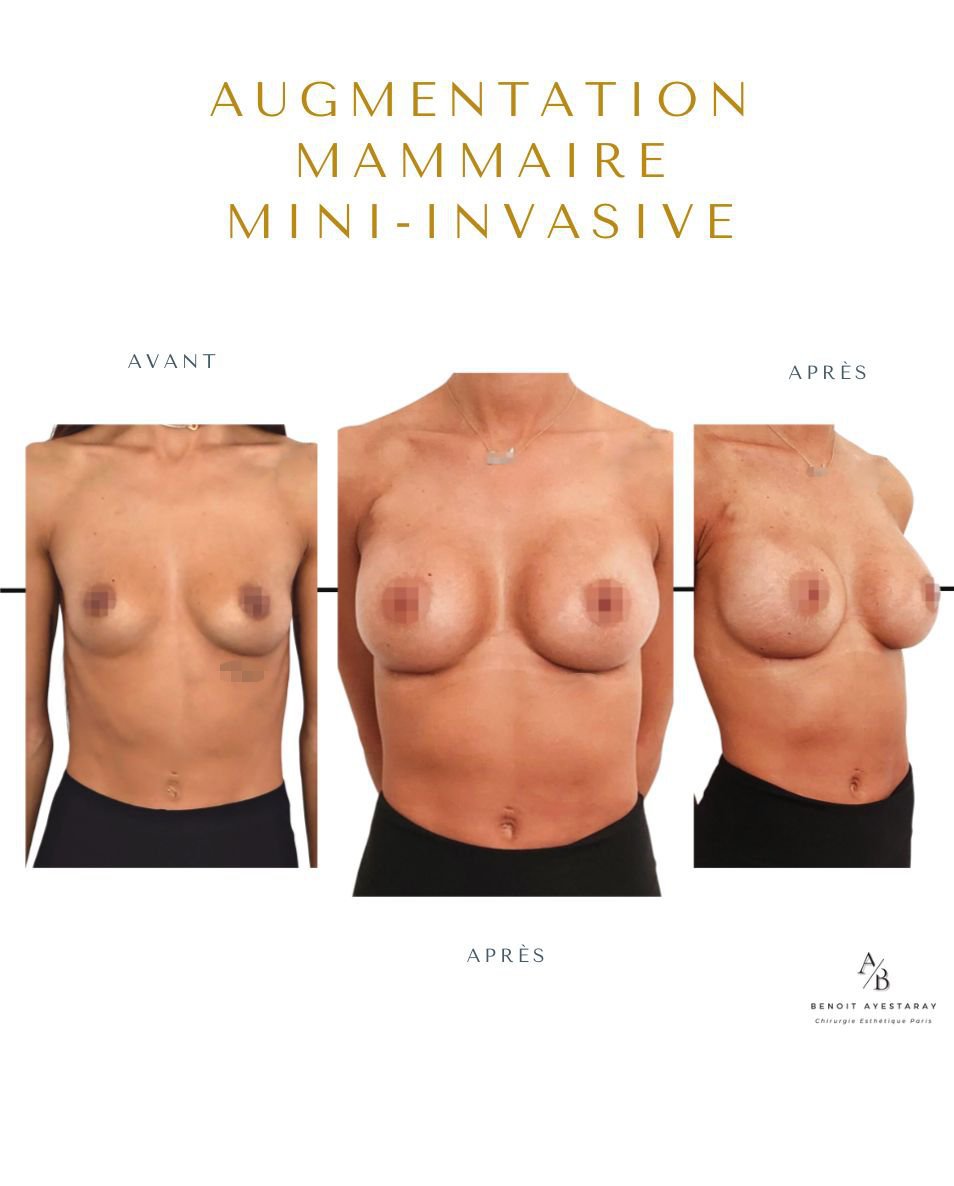 Augmentation mammaire par prothèses à Paris 13 Augmentation mammaire à Paris – résultat avant après n°3, Dr Ayestaray