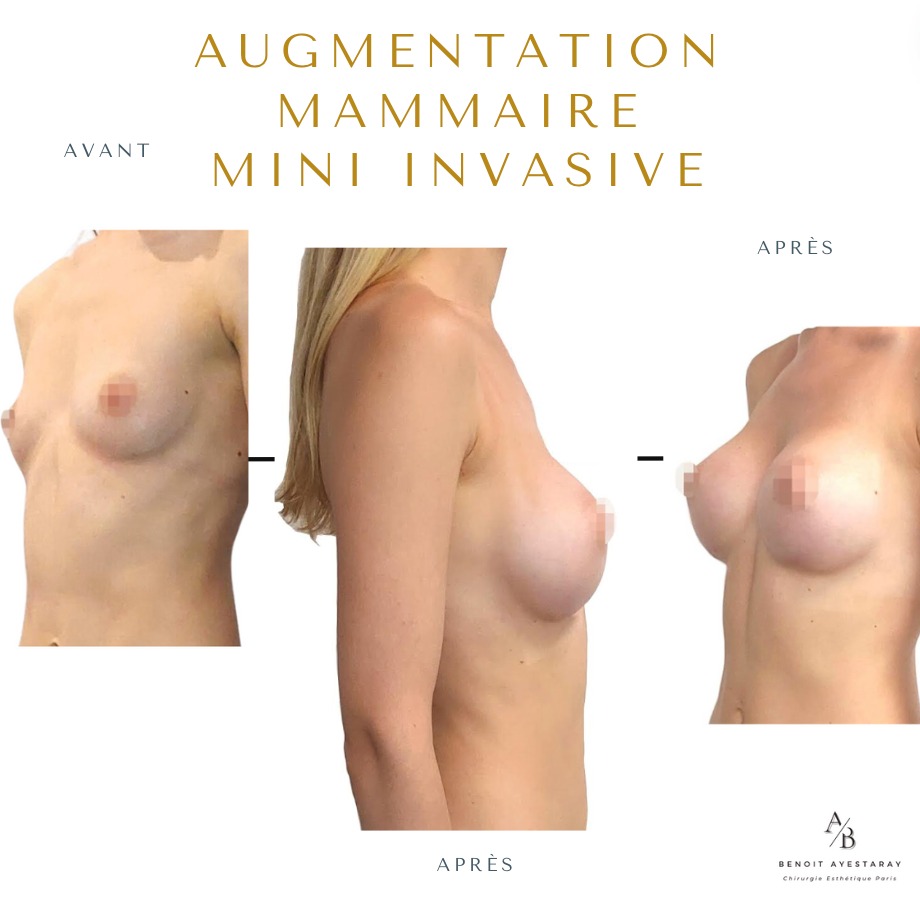 Augmentation mammaire par prothèses à Paris 2 Résultat augmentation mammaire technique Mia Femtech à Paris