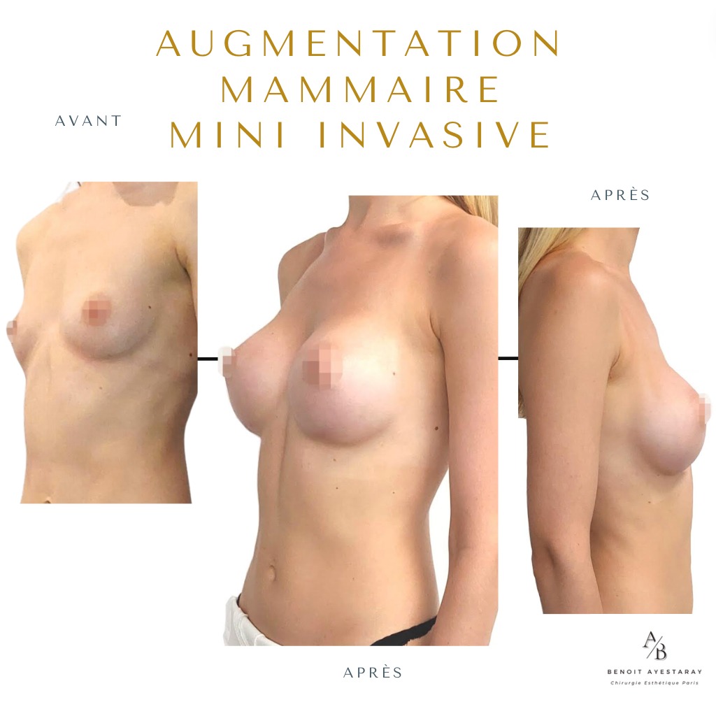 Augmentation mammaire par prothèses à Paris 3 Augmentation mammaire à Paris – résultat naturel, Dr Benoit Ayestaray