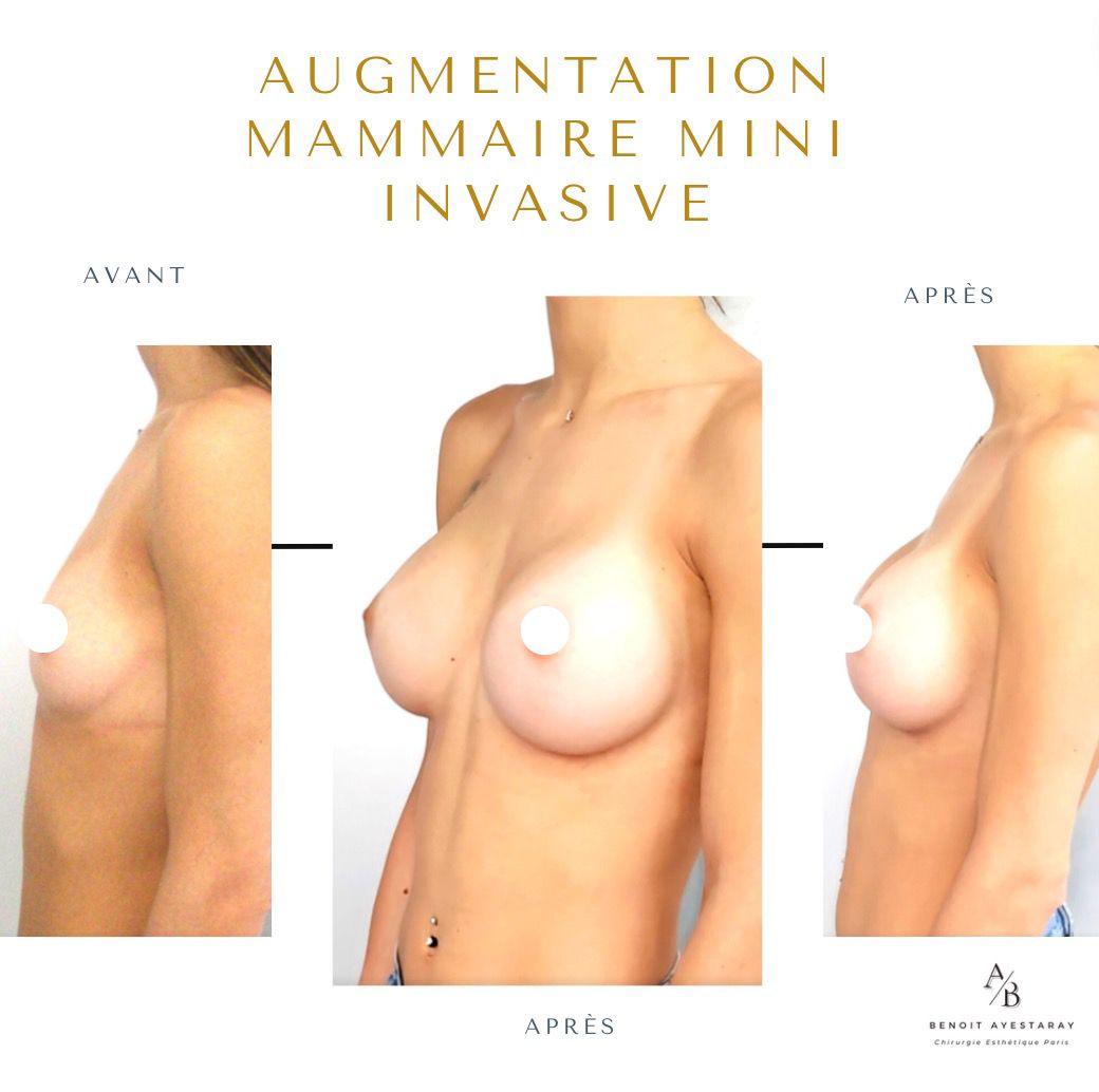 Augmentation mammaire par prothèses à Paris 9 Résultat augmentation mammaire Mia Femtech n°2 – Paris