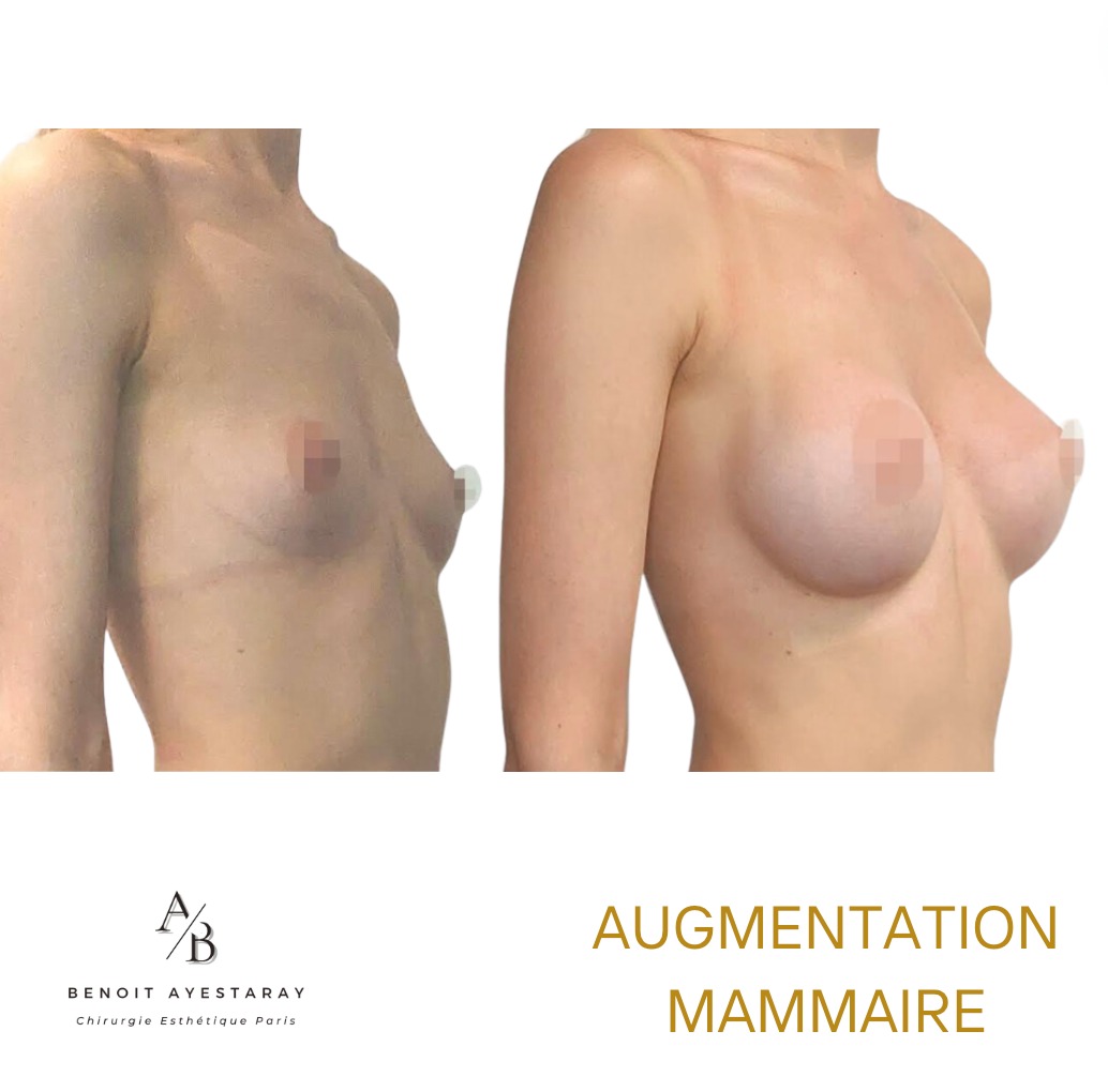 Augmentation mammaire par prothèses à Paris 4 Technique Mia Femtech – augmentation mammaire mini-invasive Paris