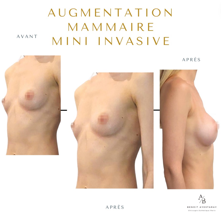 Augmentation mammaire par prothèses à Paris 5 Résultat Mia Femtech à Paris – augmentation mammaire
