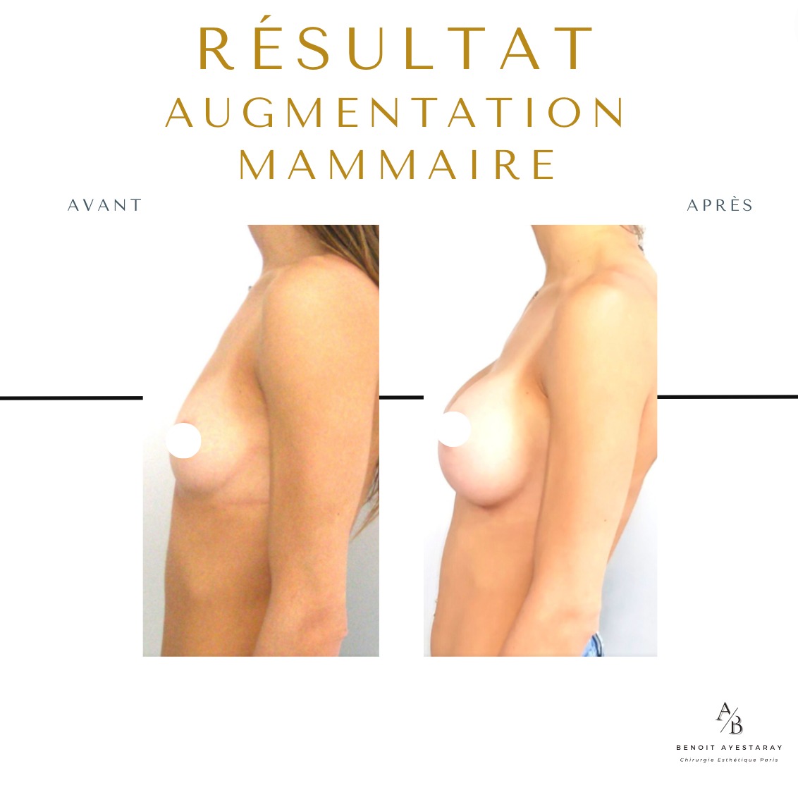 Augmentation mammaire par prothèses à Paris 10 Prothèse mammaire – résultat augmentation à Paris
