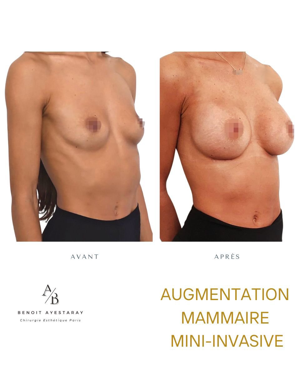Augmentation mammaire par prothèses à Paris 12 Prothèses mammaires – autre résultat, augmentation Paris