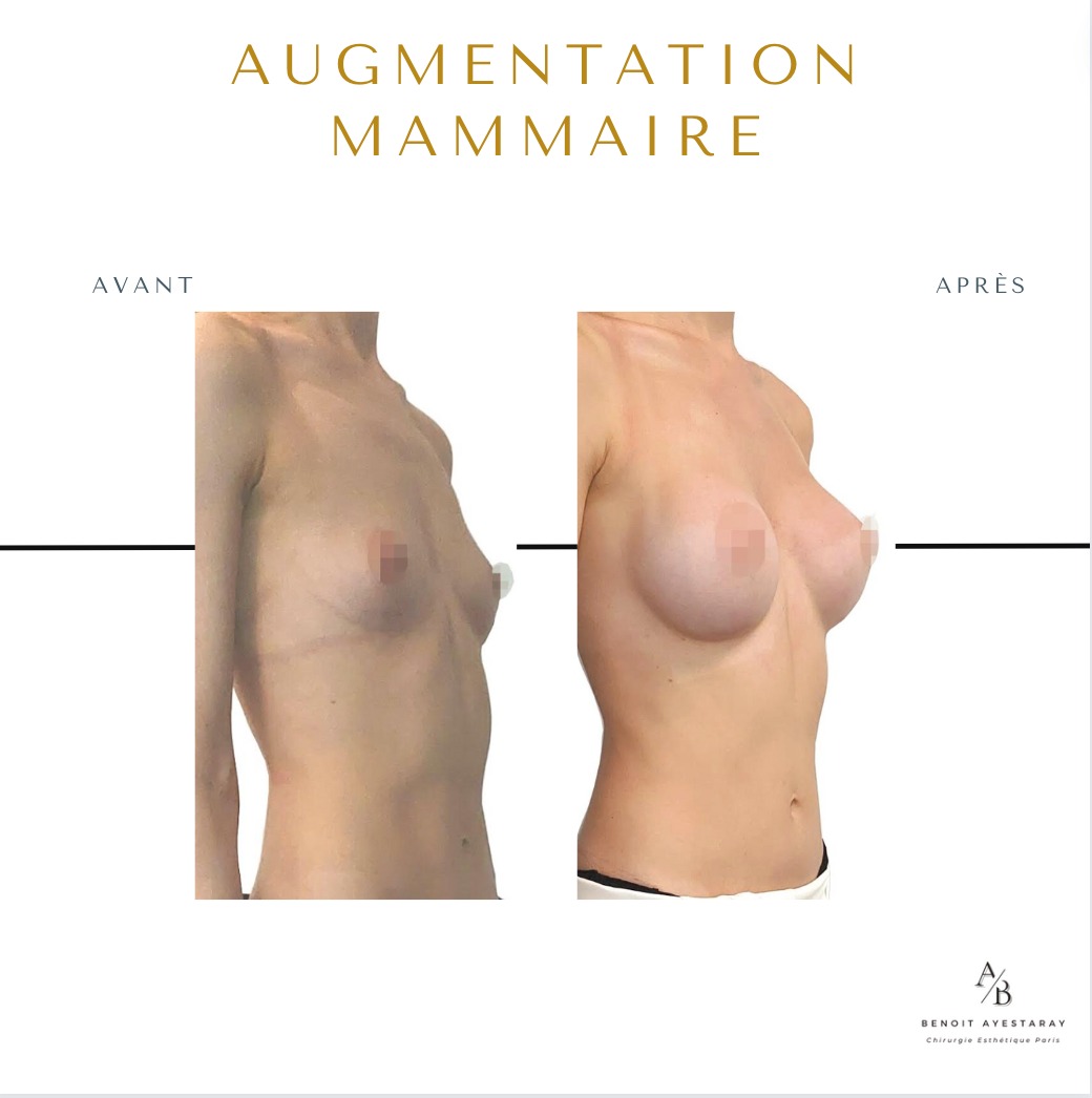 Augmentation mammaire par prothèses à Paris 7 Prothèses mammaires à Paris – résultat post-opératoire