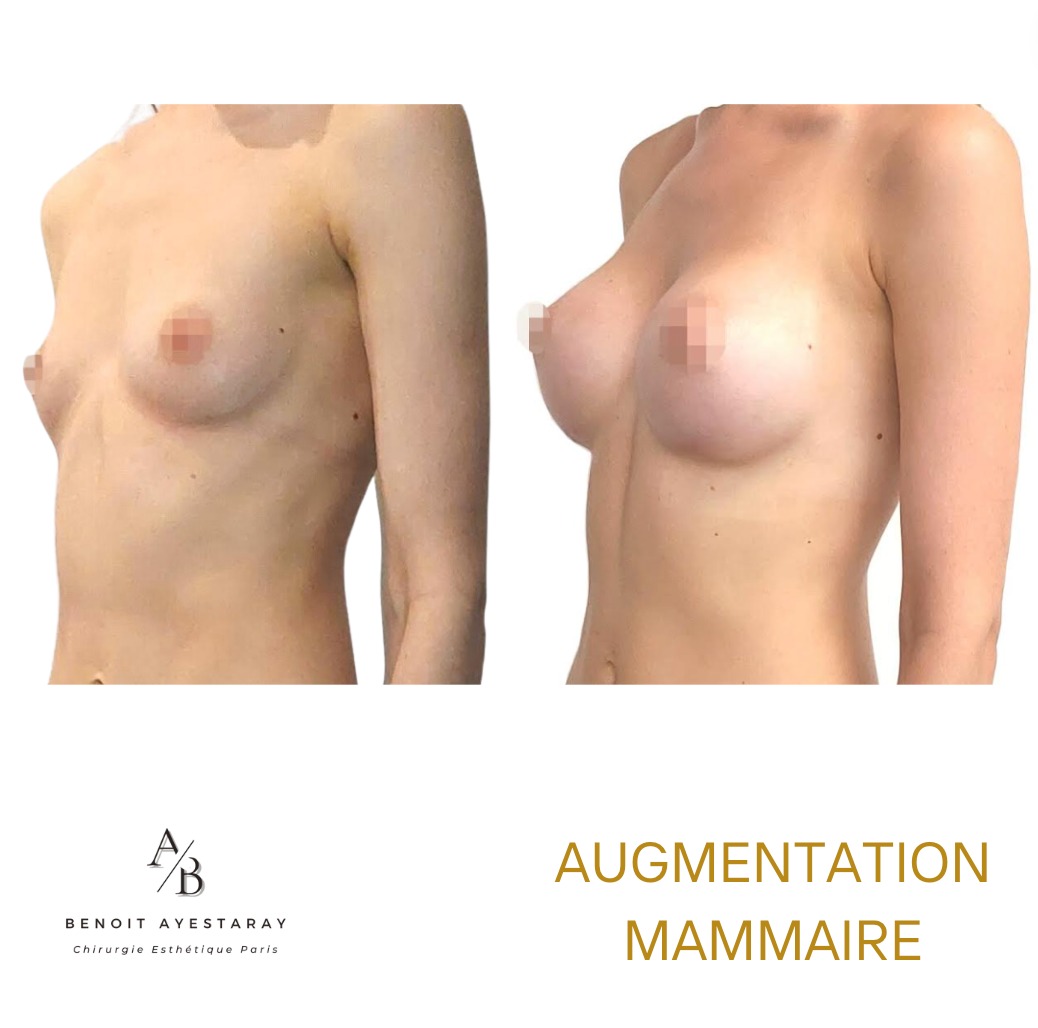 Augmentation mammaire par prothèses à Paris 6 Prothèses mammaires en silicone – résultat à Paris