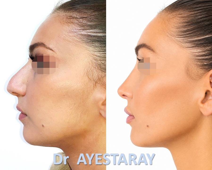 Rhinoplastie Ultrasonique à Paris 19 rhinoplastie-paris