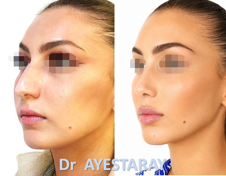 Rhinoplastie Ultrasonique à Paris 20 rhinoplastie-ultrasonique