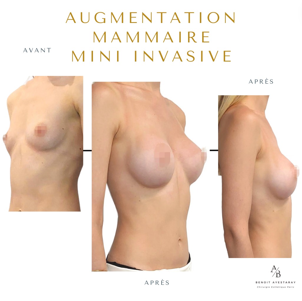 Augmentation mammaire par prothèses à Paris 8 Technique Mia – augmentation mammaire mini-invasive, résultat Paris