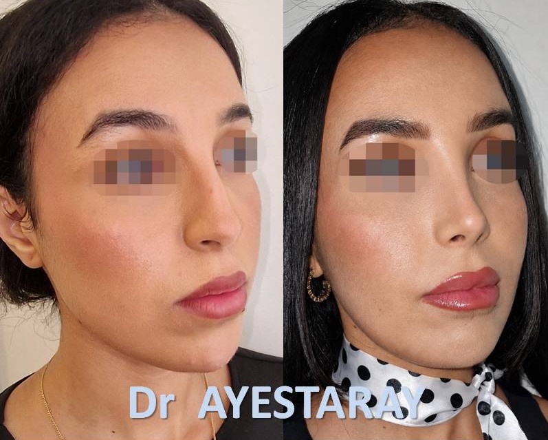 Rhinoplastie Ultrasonique à Paris 26 rhinoplastie-paris