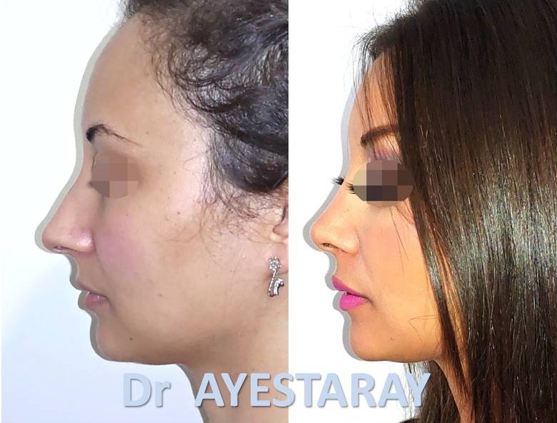 Rhinoplastie Ultrasonique à Paris 21 rhinoplastie-paris