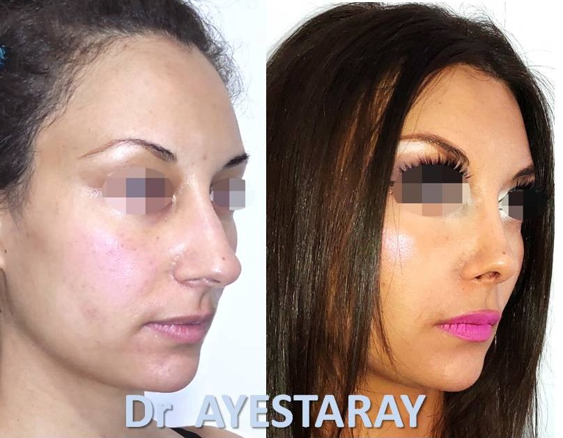Rhinoplastie Ultrasonique à Paris 24 rhinoplastie-ultrasonique