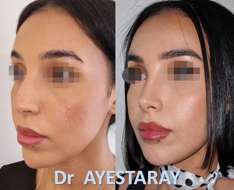 Rhinoplastie Ultrasonique à Paris 25 rhinoplastie-ultrasonique