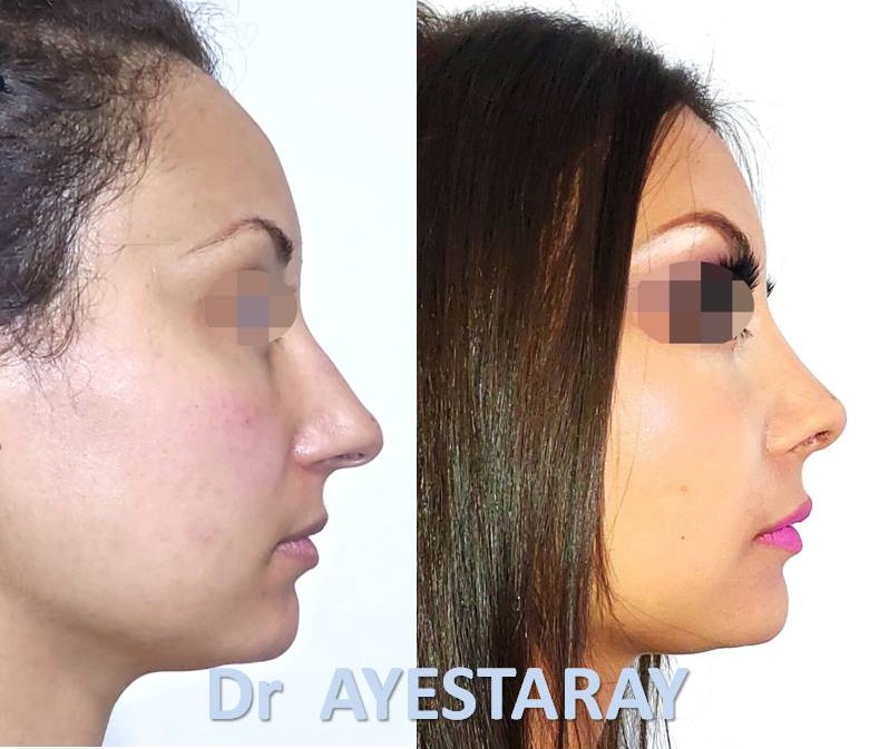 Rhinoplastie Ultrasonique à Paris 23 rhinoplastie-ultrasonique-paris