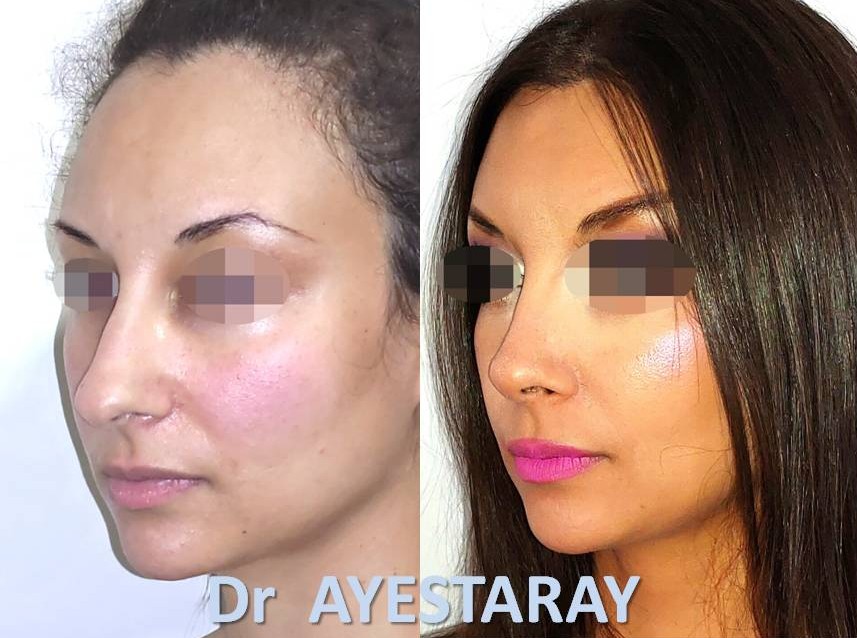 Rhinoplastie Ultrasonique à Paris 22 rhinoplastie-ultrasonique